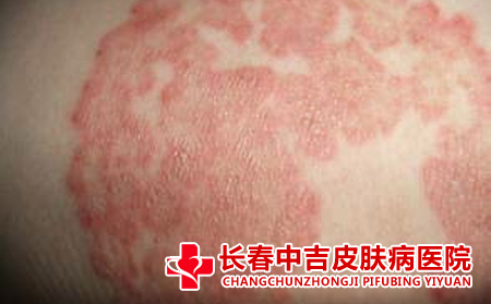 皮炎与湿疹的特征区别