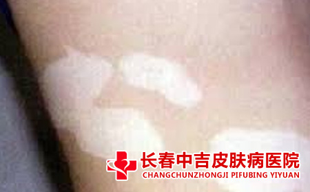 白癜风护理