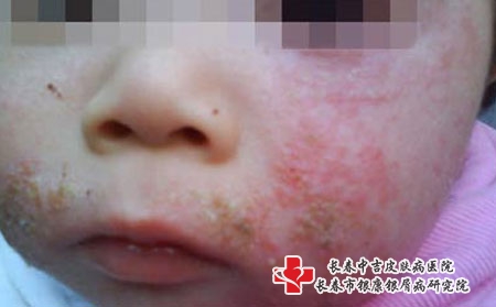 婴儿湿疹的类型，婴儿怎么做好日常护理？