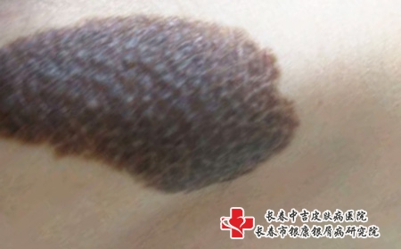 哪些是良性胎记？哪些胎记有危害？