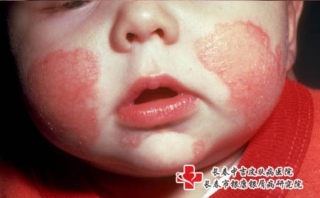 婴儿湿疹的症状和表现有哪些