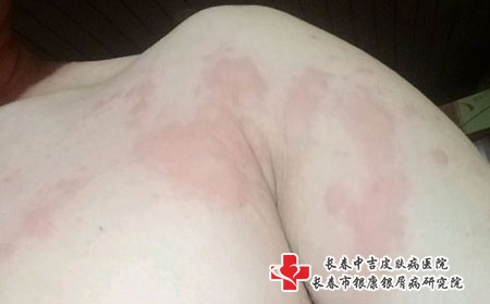 中医是如何分型治疗荨麻疹的