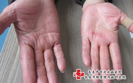 掌跖脓疱银屑病用药后发红蜕皮是为什么