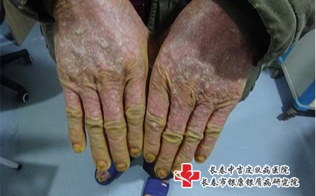 [长春治疗牛皮癣的好的医院]手部牛皮癣治疗方法