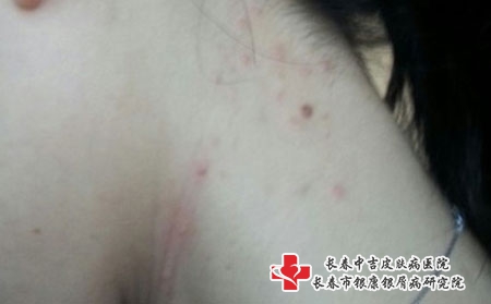 [长春痤疮荏然中吉a]痤疮可能由什么引起