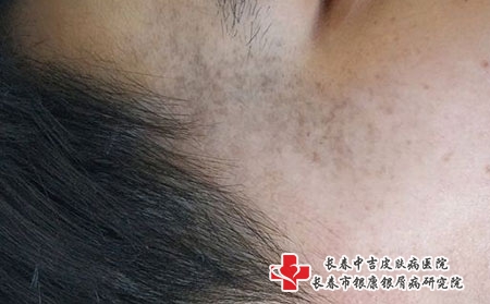 长春胎记医院哪里好?胎记的类型有哪些?