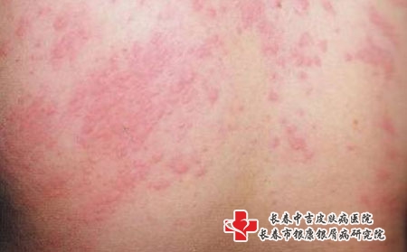 长春诱发神经性皮炎的病因是什么?长春治疗皮炎专科