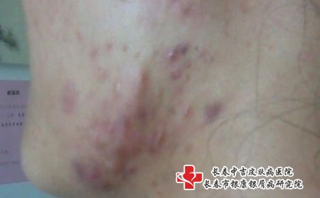 如何区分毛囊炎和痤疮，长春痤疮哪家医院看的好