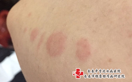 哪些原因会导致皮炎疾病的出现，长春治疗皮炎专科