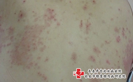 湿疹导致皮肤瘙痒怎么办，长春专治湿疹的医院