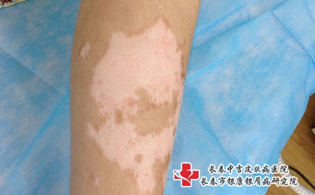 长春白癜风哪个医院治疗好，长春治疗白癜风专科