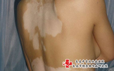 诱发白癜风的原因，长春去哪儿治疗白癜风?