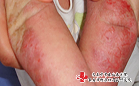 常见的皮炎类型有哪些-长春皮炎治疗医院?