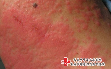 皮炎湿疹有哪些症状_长春哪个医院治疗湿疹?