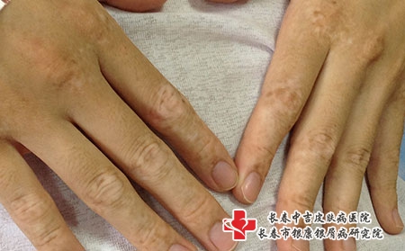 白癜风的治疗该怎么做?长春白癜风哪家医院看的好