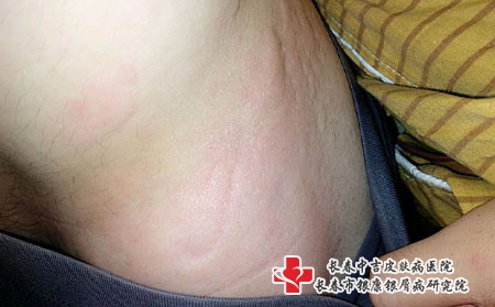 长春中吉讲解皮炎的症状?长春治疗皮炎医院有哪家呢