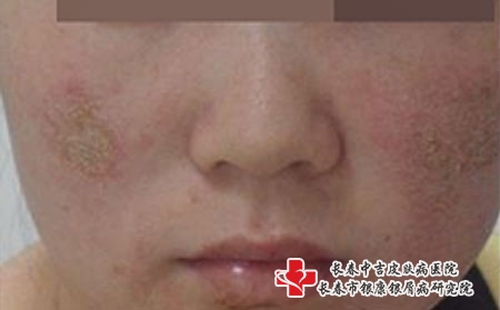 化妆品皮炎会有哪些症状-长春哪里治疗皮炎较好?