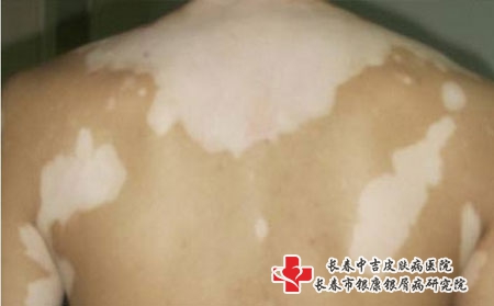 白癜风是什么样子的
