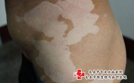 白癜风有哪些症状表现