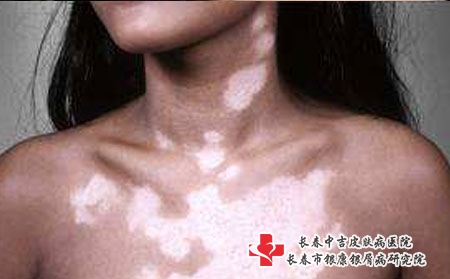 白癜风患者应该怎么面对疾病?