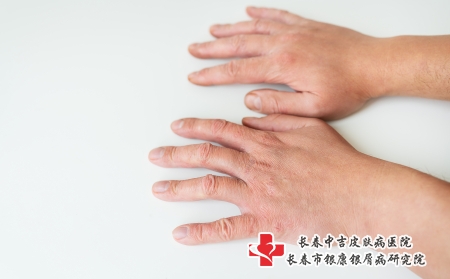 摄图网_327119749_治疗皮肤病 ţƤѢ 湿疹 皮炎 素质 在人的手上 皮肤病学方向的医学理念和治疗（企业商用）