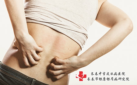 摄图网_304129678_人类抓痒的背皮肤过敏疹健康问题（企业商用）