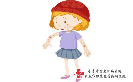 摄图网_401477102_长湿疹的女孩（企业商用）
