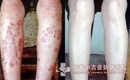 多年湿疹幸得长春中吉治好_长春中吉皮肤病医