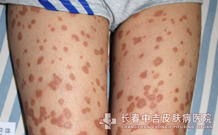 银屑病患者如何诊断自己的病情?