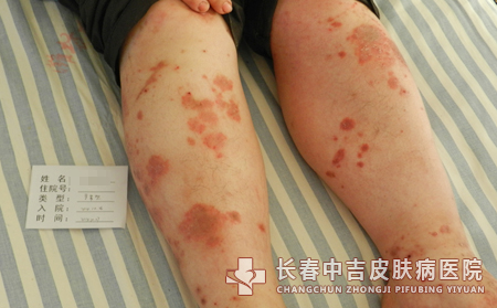 长春中吉皮肤病医院的医生周末上班吗