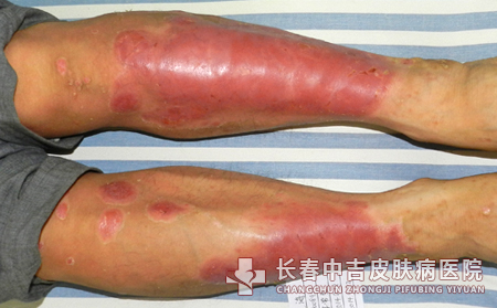 长春银屑病总是治不合适原因出在哪里