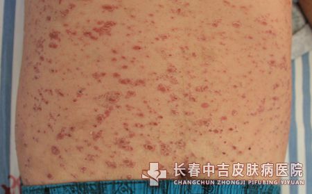 银屑病是怎么引起来的
