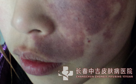 长春中吉治牛皮癣的医院治皮肤病吗