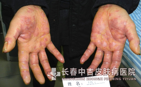 典型银屑病的病因有哪些