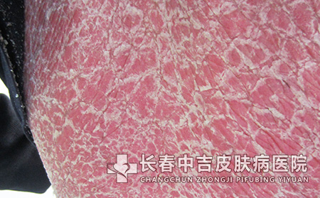 牛皮癣在发病初期身体会出现哪些症状