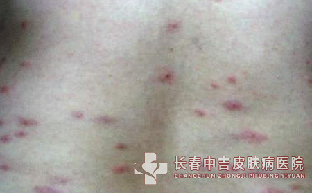 寒冷性荨麻疹_什么是寒冷性荨麻疹