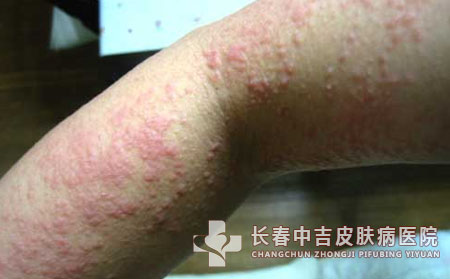 夏季怎么预防湿疹_长春中吉皮肤病医院