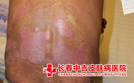导致银屑病发生的原因是什么