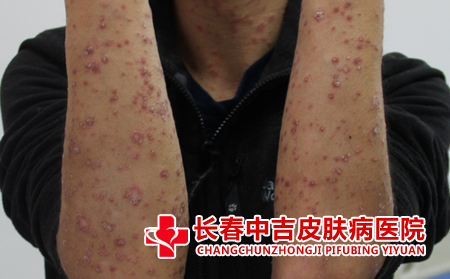 银屑病的症状有什么