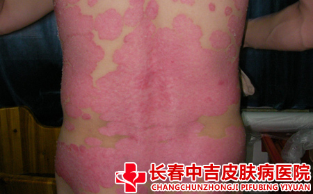 牛皮癣患者补充蛋白质