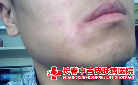 脸上掉皮长红斑是不是银屑病