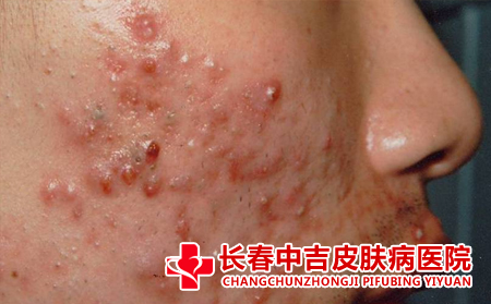 脸上长痤疮在生活中要注意什么