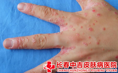 患上银屑病的原因