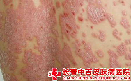 导致银屑病出现的原因有哪些