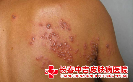 带状疱疹的诱发因素有哪些