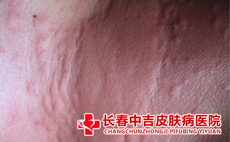 荨麻疹和潮湿有关吗