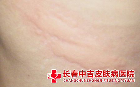 得了荨麻疹反复发作怎么办