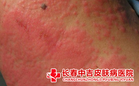 怎么治疗手指头之间的湿疹