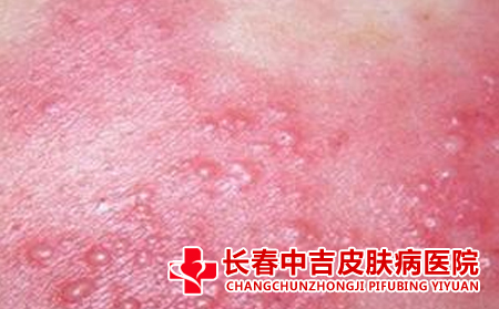 吃什么食物合适帮助治疗手上的湿疹