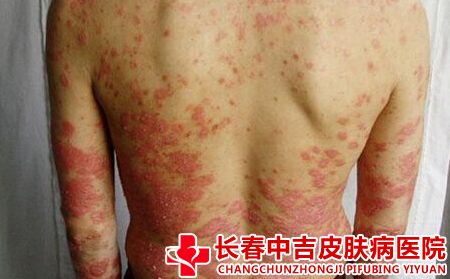 为什么到了中年很多男性开始得牛皮癣了